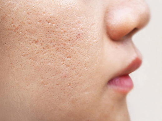 Acne Marks vs Acne Scars: How To Tell The Difference?
