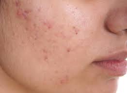 Fungal Acne vs Closed Comedones: Causes, Treatments, Appearances