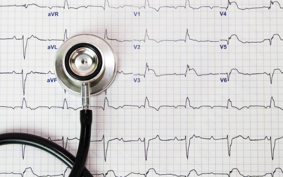 Causes of Atrial Fibrillation Mnemonic: PIRATES, SMITH
