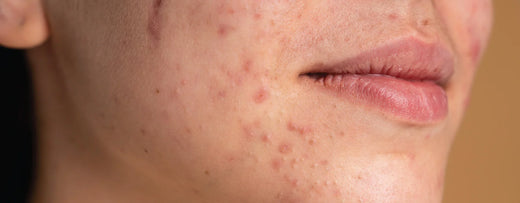 Bacterial Acne vs Fungal Acne: What's the Difference?